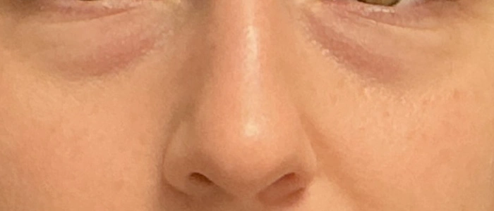 Eyelid Surgery case #18510