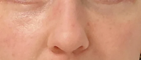 Eyelid Surgery case #18510