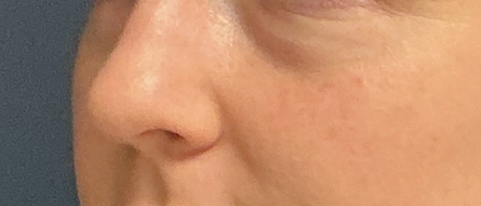 Eyelid Surgery case #18510