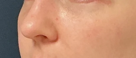 Eyelid Surgery case #18510