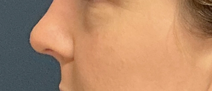 Eyelid Surgery case #18510