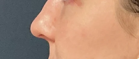 Eyelid Surgery case #18510