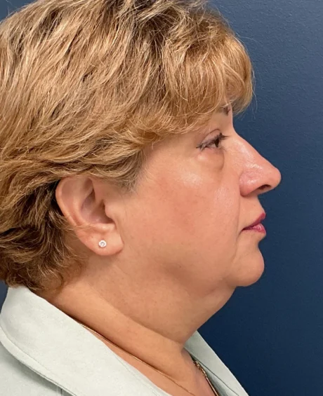 Eyelid Surgery case #18524