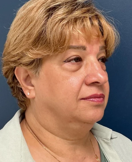 Eyelid Surgery case #18524