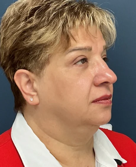 Eyelid Surgery case #18524