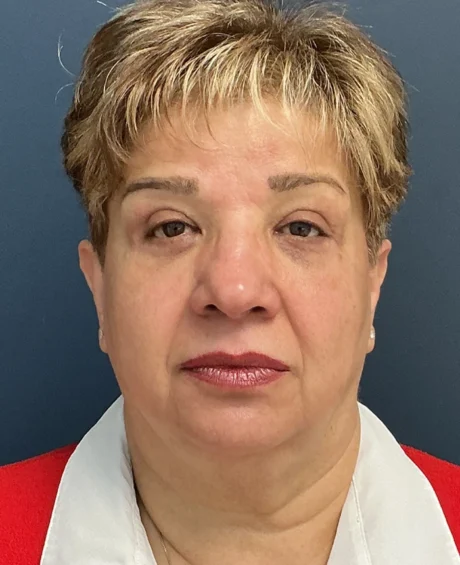 Eyelid Surgery case #18524