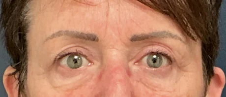 Eyelid Surgery case #18520