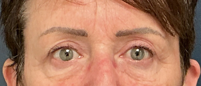 Eyelid Surgery case #18520