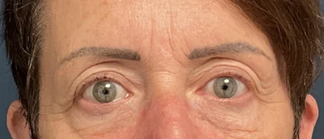 Eyelid Surgery case #18520