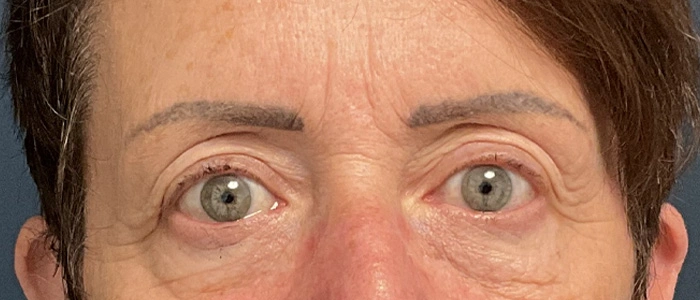 Eyelid Surgery case #18520