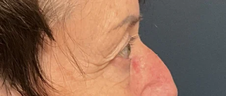 Eyelid Surgery case #18520