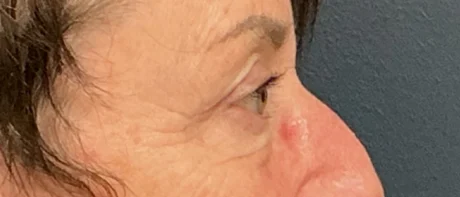 Eyelid Surgery case #18520