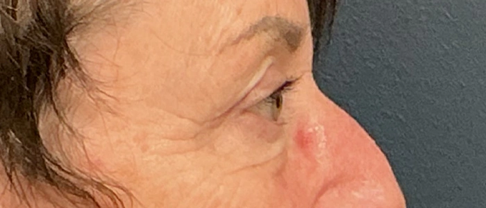Eyelid Surgery case #18520