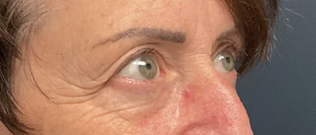 Eyelid Surgery case #18520