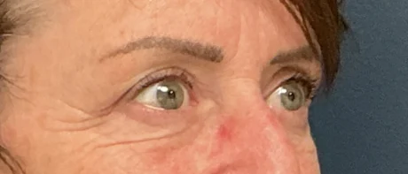 Eyelid Surgery case #18520