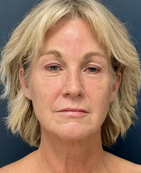 Eyelid Surgery case #18522