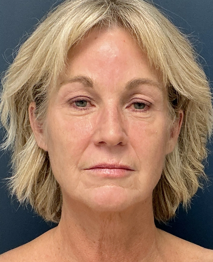 Eyelid Surgery case #18522