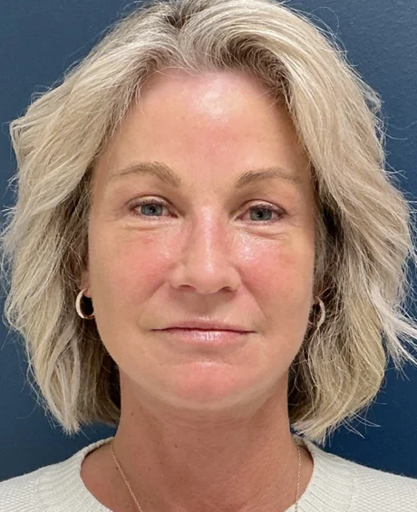 Eyelid Surgery case #18522