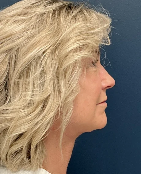 Eyelid Surgery case #18522