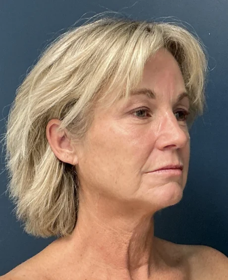 Eyelid Surgery case #18522