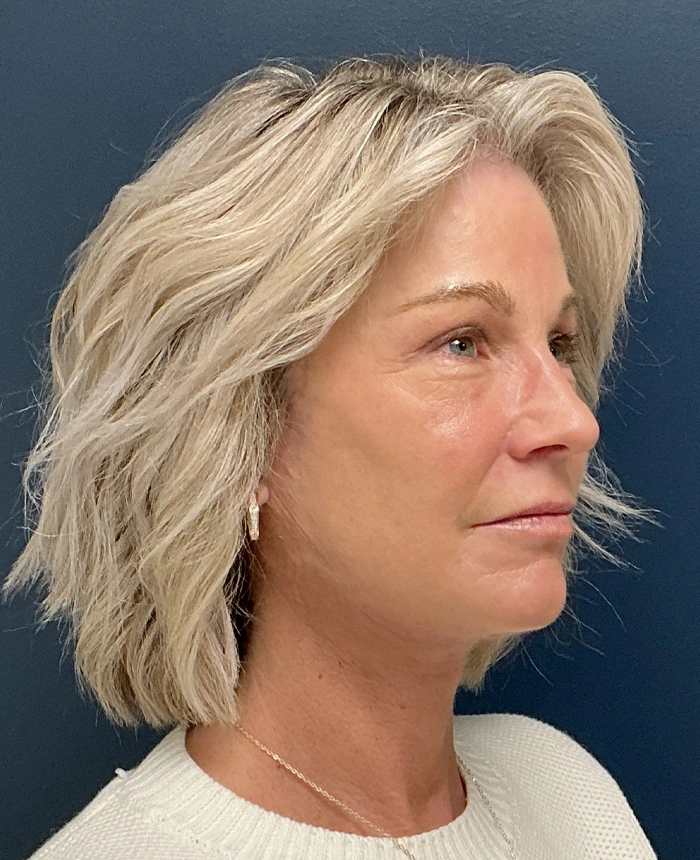 Eyelid Surgery case #18522