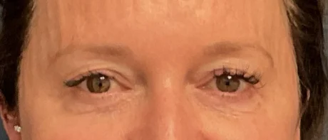 Eyelid Surgery case #18521