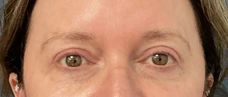 Eyelid Surgery case #18521