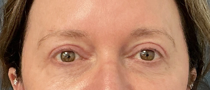 Eyelid Surgery case #18521