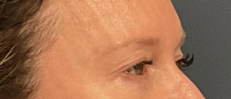 Eyelid Surgery case #18521