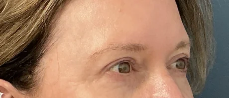 Eyelid Surgery case #18521