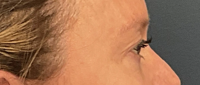 Eyelid Surgery case #18521