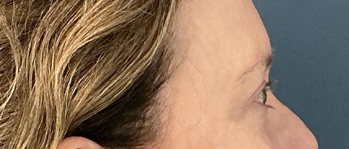 Eyelid Surgery case #18521