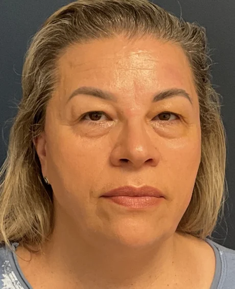 Eyelid Surgery case #18523