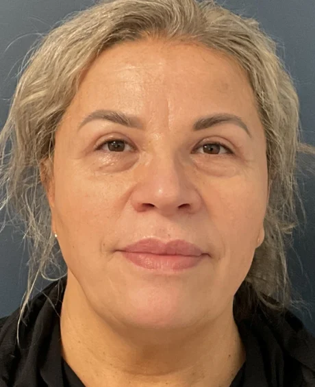 Eyelid Surgery case #18523