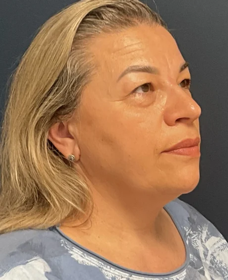 Eyelid Surgery case #18523