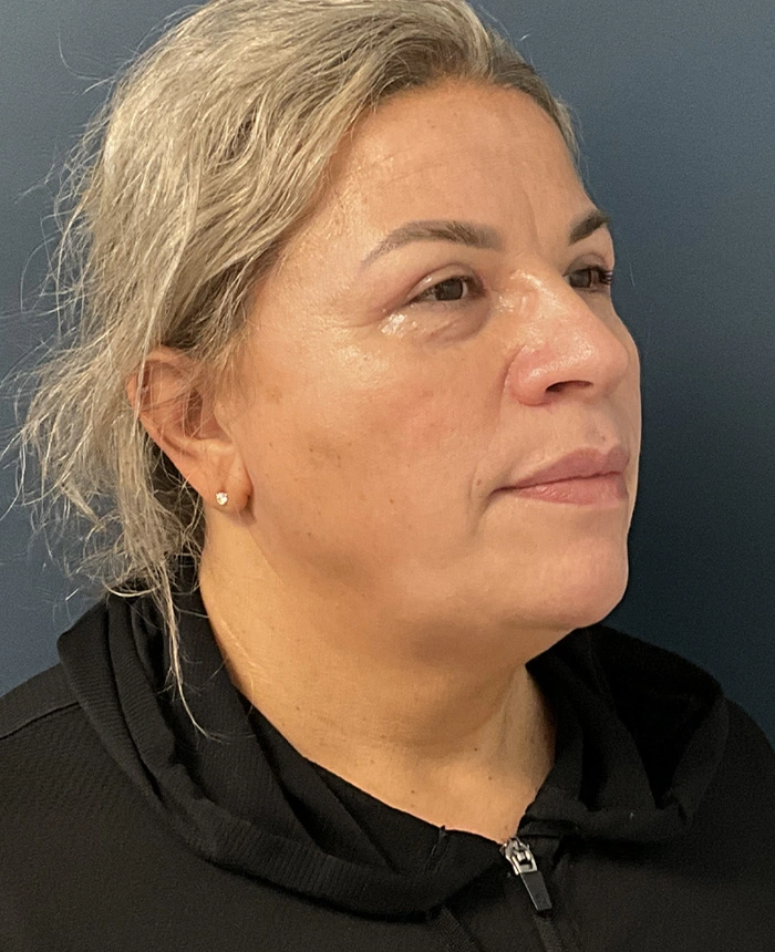 Eyelid Surgery case #18523