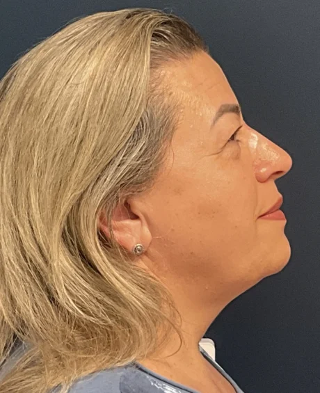 Eyelid Surgery case #18523