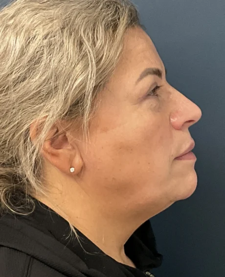 Eyelid Surgery case #18523