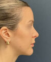 Rhinoplasty case #18479