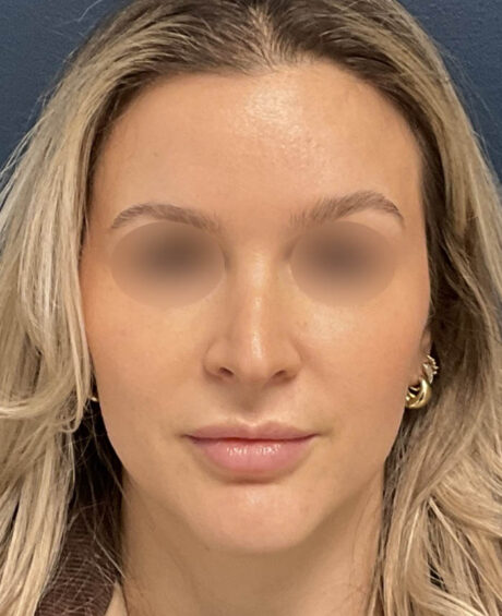 Rhinoplasty case #18479