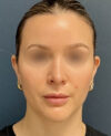 Rhinoplasty case #18479