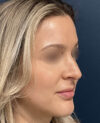 Rhinoplasty case #18479