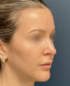 Rhinoplasty case #18479