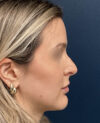 Rhinoplasty case #18479