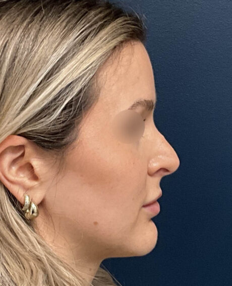 Rhinoplasty case #18479