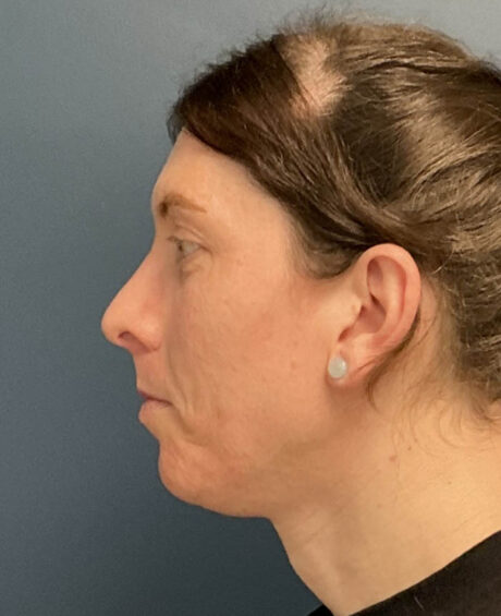 Facial Feminization Surgery case #18451