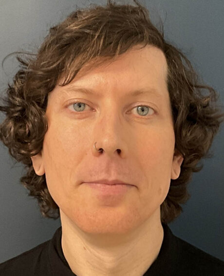 Facial Feminization Surgery case #18451