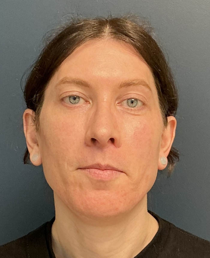 Facial Feminization Surgery case #18451