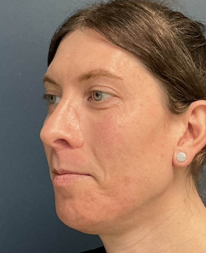 Facial Feminization Surgery case #18451