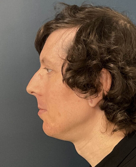Facial Feminization Surgery case #18451